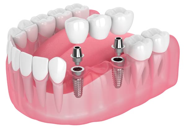 Tooth Replacement - Multiple Teeth